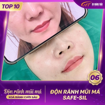 ĐỘN RÃNH MŨI MÁ